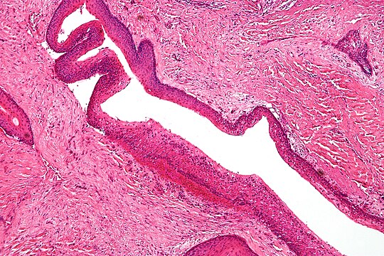 "Keratocystic_odontogenic_tumour_-_intermed_mag.jpg" by User:Nephron