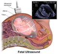 "Fetal_Ultrasound.png" by User:BruceBlaus