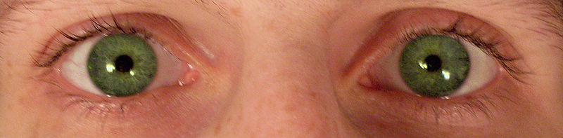 File:Myosis due to opiate use.jpg